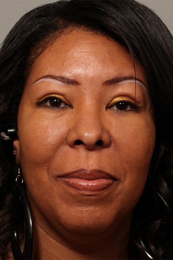 After Image: Upper Blepharoplasty and Ptosis Repair - front