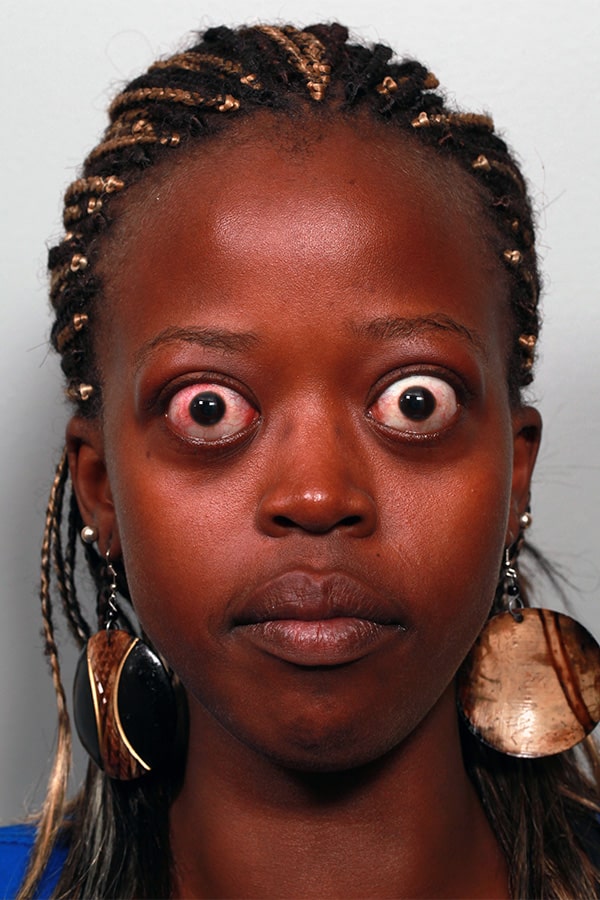 Before Image: Graves Disease - front