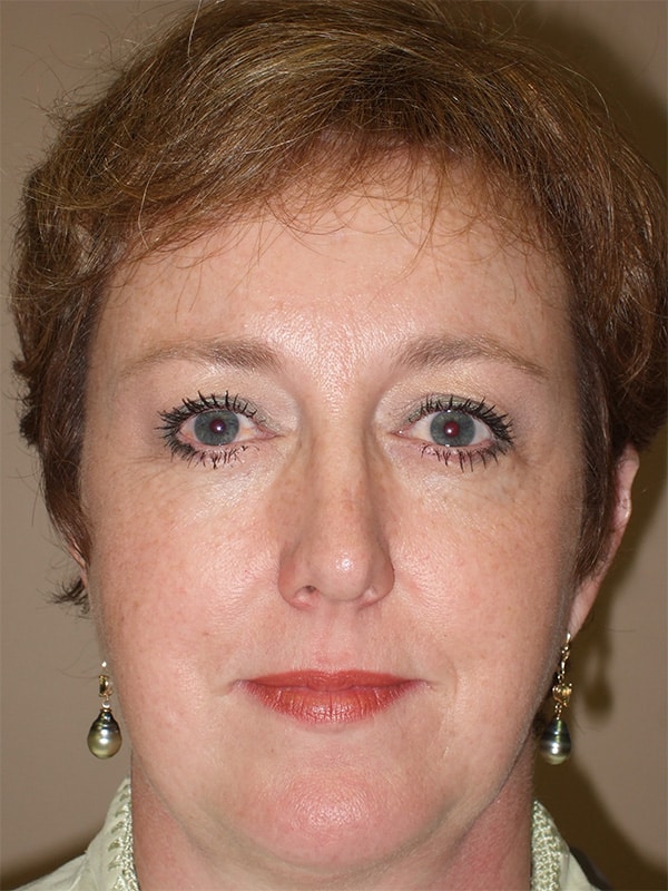 After Image: Endoscopic Browlift - front