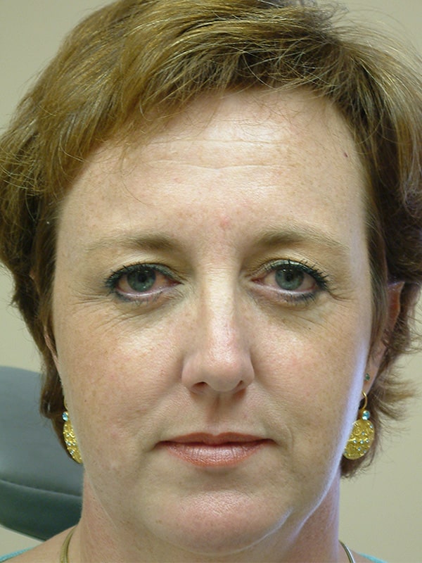 Before Image: Endoscopic Browlift - front