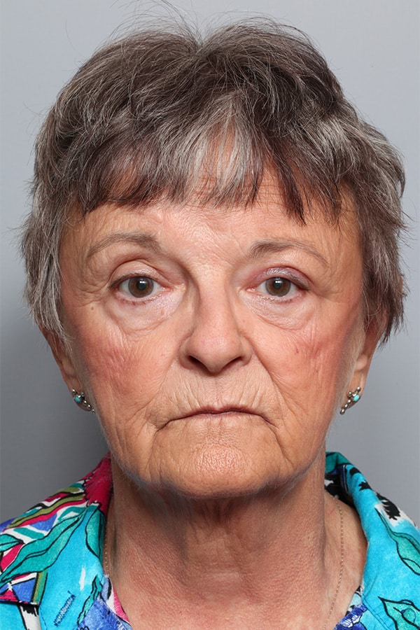 After Image: Orbital Celulitis - front