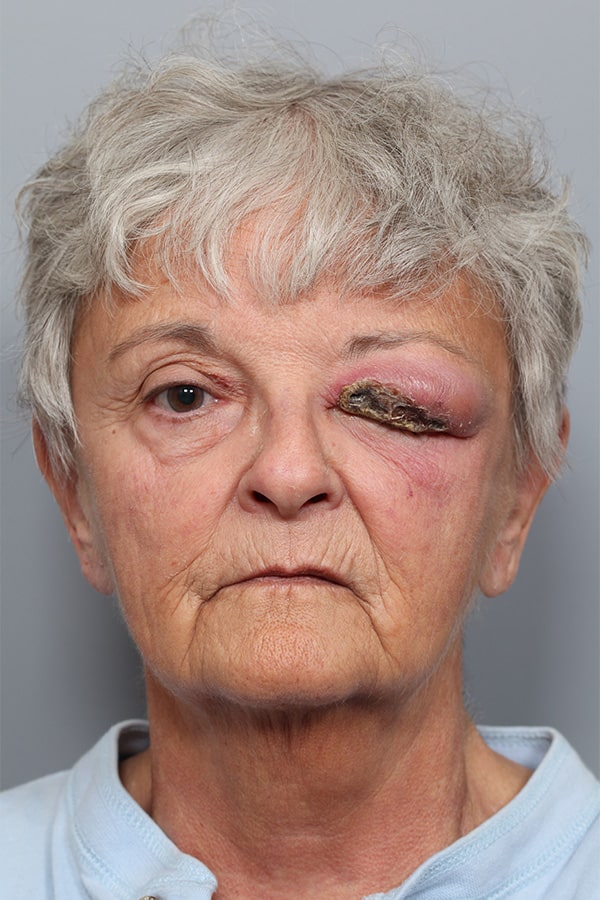Before Image: Orbital Celulitis - front