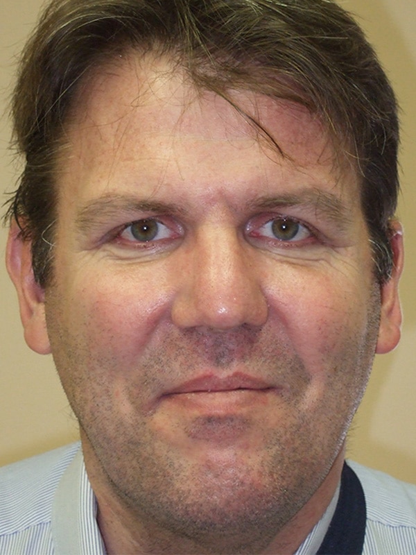 After Image: Ptosis Repair - front