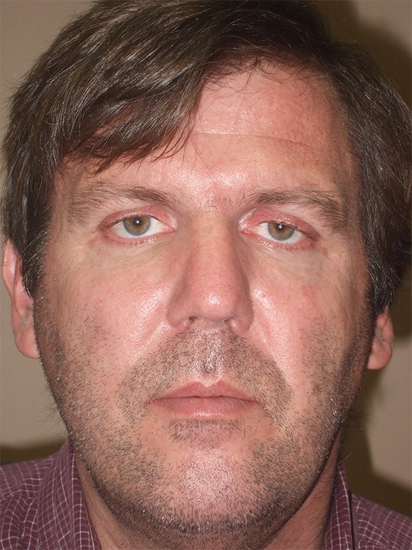 Before Image: Ptosis Repair - front