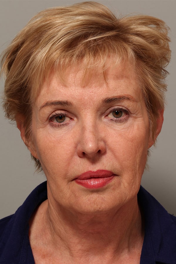 Before Image: Facelift and Necklift - front