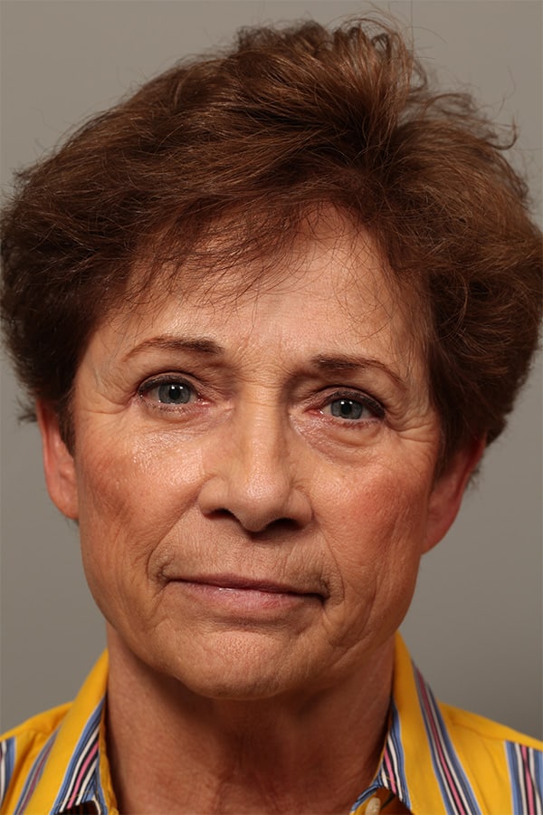 After Image: Upper & Lower Blepharoplasty - front