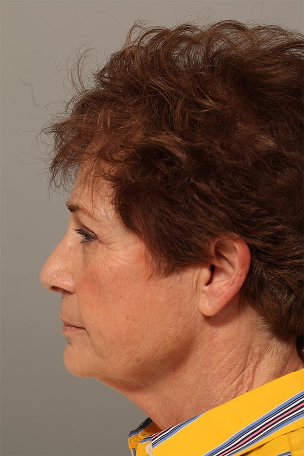 After Image: Upper & Lower Blepharoplasty - left-side