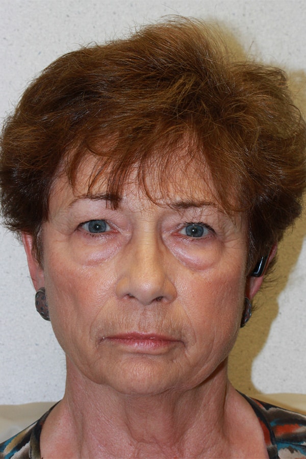 Before Image: Upper & Lower Blepharoplasty - front