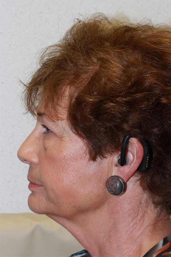 Before Image: Upper & Lower Blepharoplasty - left-side