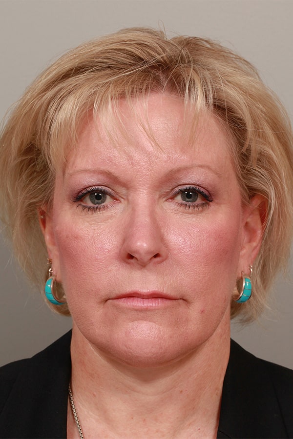 After Image: Facelift, Necklift, Upper & Lower Blepharoplasty, Fat Transfer to Perioral and Fractional CO2 Laser to Perioral - front