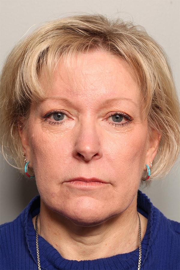 Before Image: Facelift, Necklift, Upper & Lower Blepharoplasty, Fat Transfer to Perioral and Fractional CO2 Laser to Perioral - front