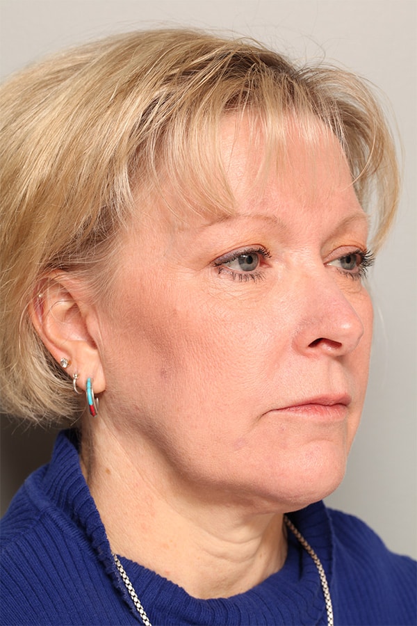 Before Image: Facelift, Necklift, Upper & Lower Blepharoplasty, Fat Transfer to Perioral and Fractional CO2 Laser to Perioral - right-front-oblique