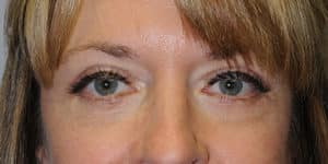Upper & Lower Blepharoplasty