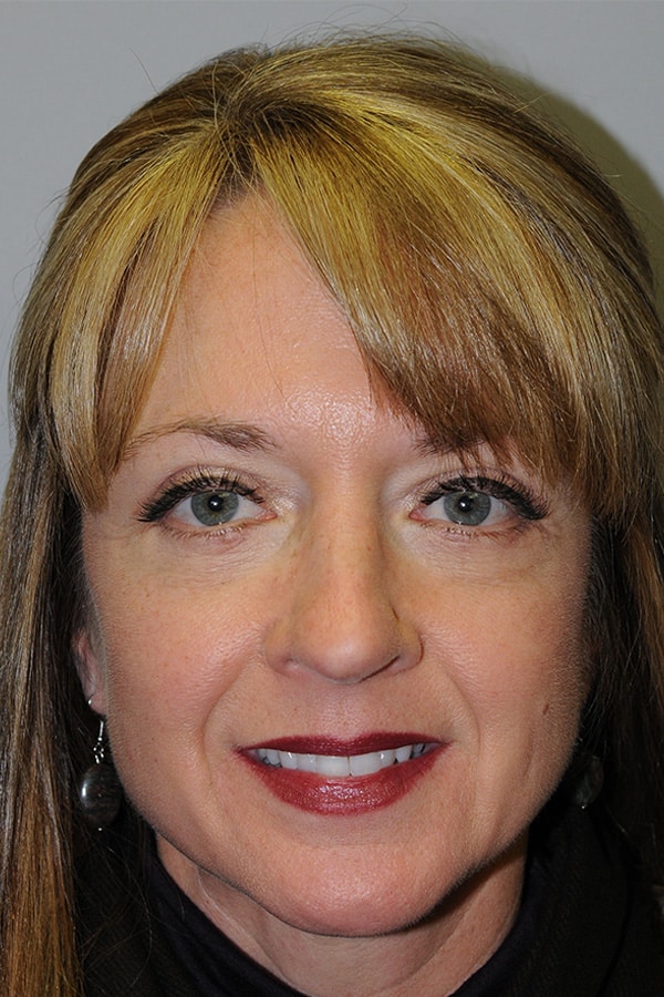 After Image: Upper & Lower Blepharoplasty - front