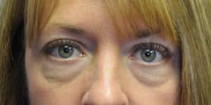 Upper & Lower Blepharoplasty