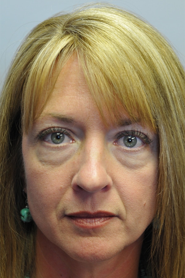 Before Image: Upper & Lower Blepharoplasty - front