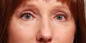 Upper Blepharoplasty and Temporal Browlift