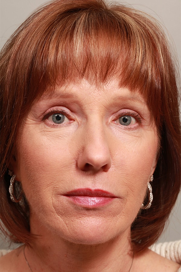 After Image: Upper Blepharoplasty and Temporal Browlift - front