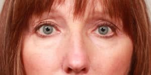 Upper Blepharoplasty and Temporal Browlift