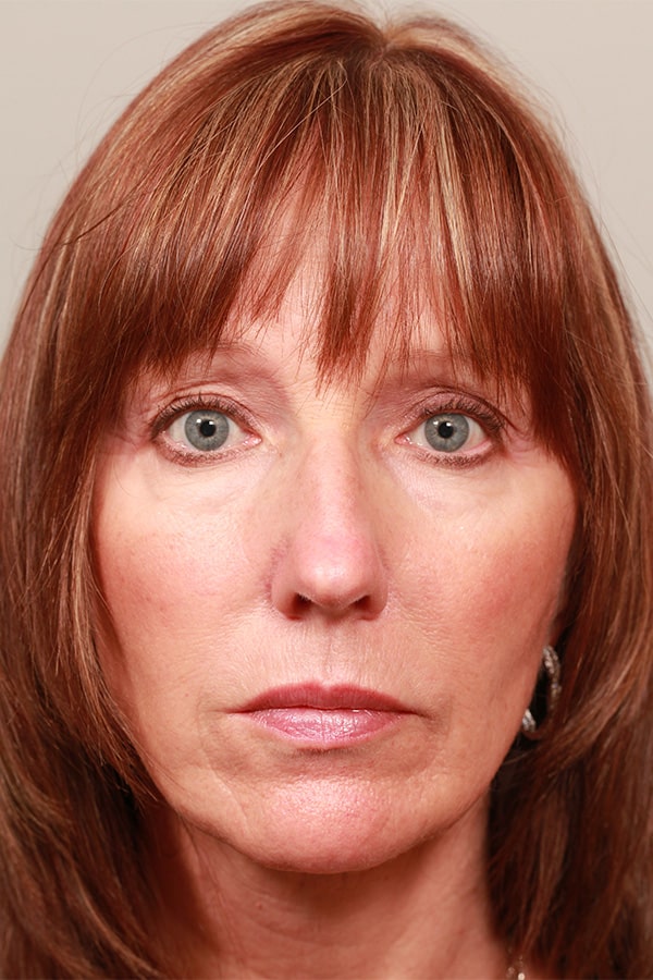 Before Image: Upper Blepharoplasty and Temporal Browlift - front