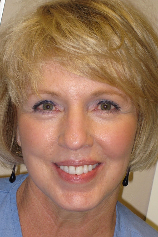 After Image: Upper & Lower Blepharoplasty, Endoscopic Browlift, Facelift and Full Face Laser Resurfacing - front