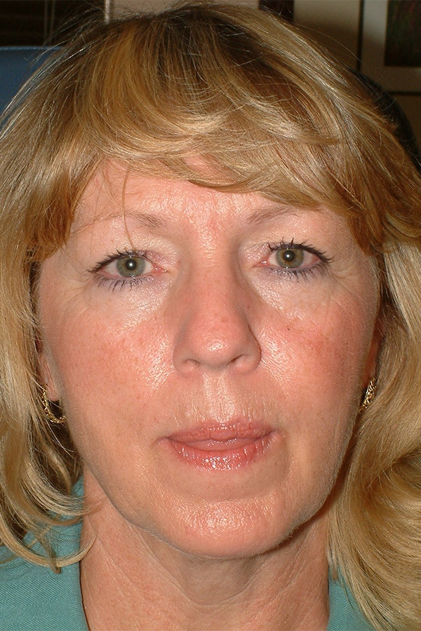 Before Image: Upper & Lower Blepharoplasty, Endoscopic Browlift, Facelift and Full Face Laser Resurfacing - front