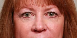Upper and Lower Blepharoplasty