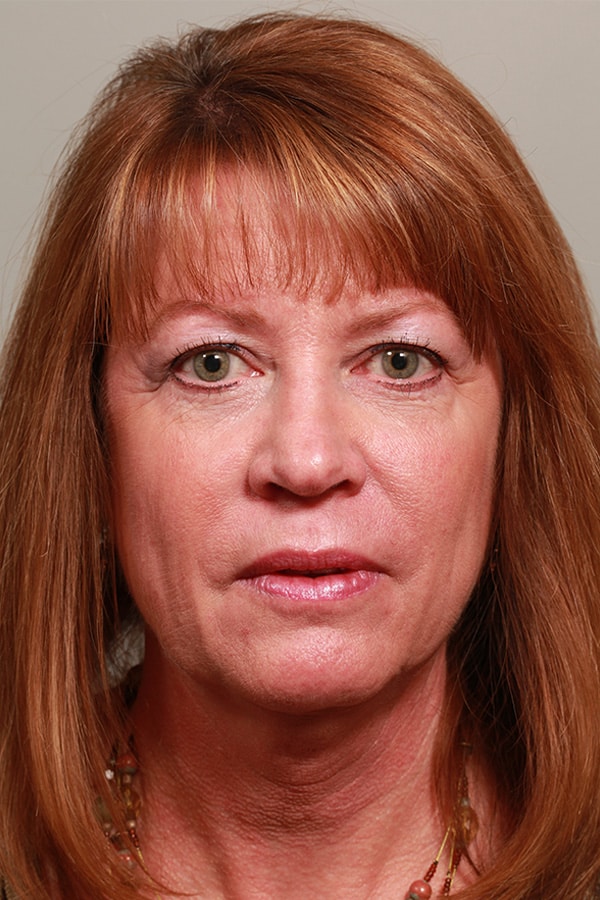 Before Image: Upper and Lower Blepharoplasty - front