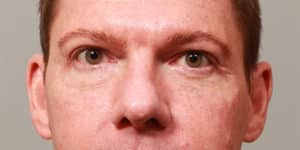 Upper & Lower Blepharoplasty