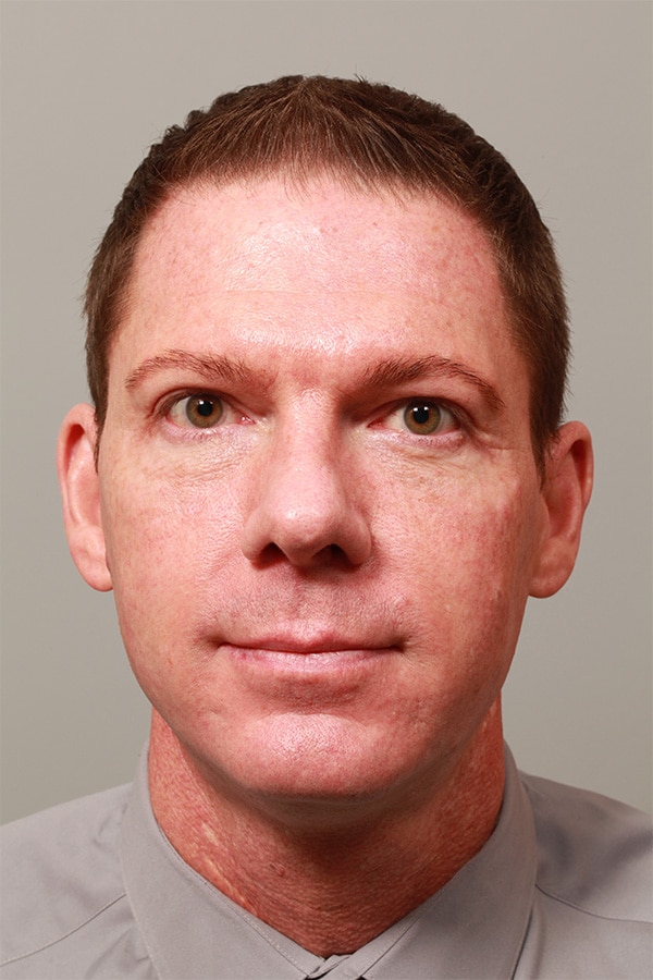 After Image: Upper & Lower Blepharoplasty - front