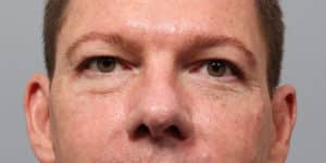 Upper & Lower Blepharoplasty
