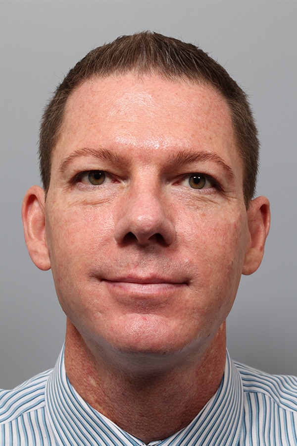 Before Image: Upper & Lower Blepharoplasty - front