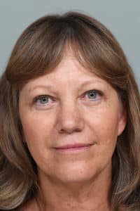 Mid-Facelift and Upper & Lower Blepharoplasty