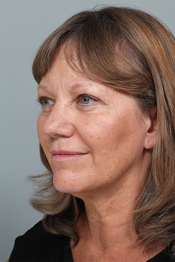 After Image: Mid-Facelift and Upper & Lower Blepharoplasty - left-front-oblique