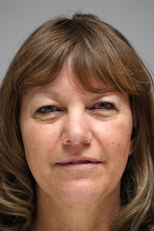 Before Image: Mid-Facelift and Upper & Lower Blepharoplasty - front