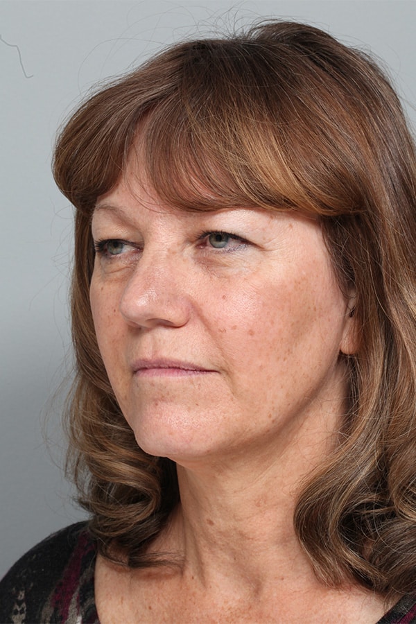 Before Image: Mid-Facelift and Upper & Lower Blepharoplasty - left-front-oblique