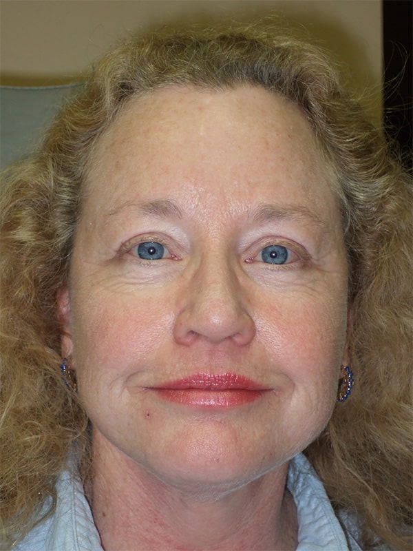After Image: Facelift, Necklift, Upper & Lower Blepharoplasty, Ptosis Repair and Endoscopic Browlift - front