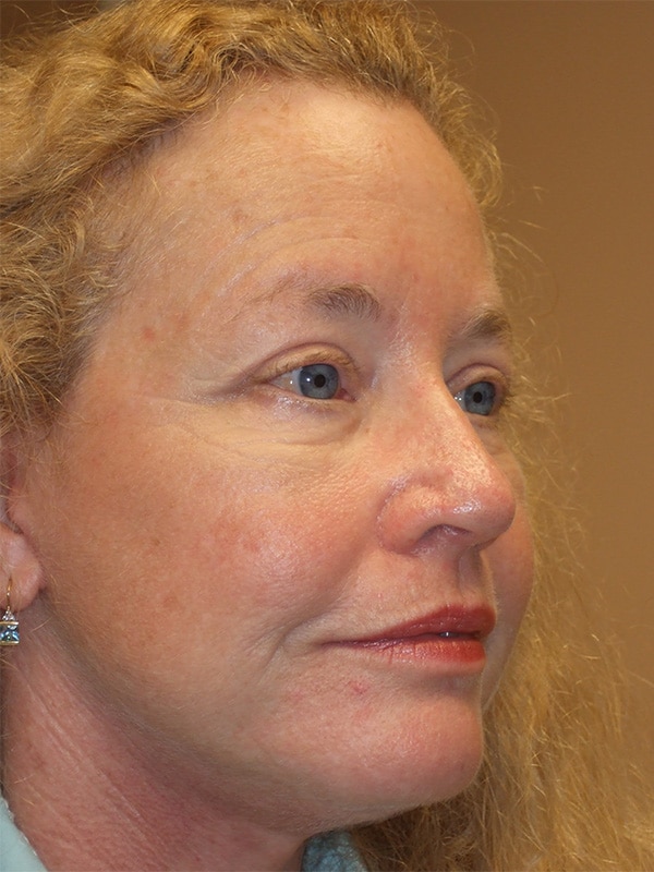 After Image: Facelift, Necklift, Upper & Lower Blepharoplasty, Ptosis Repair and Endoscopic Browlift - right-front-oblique
