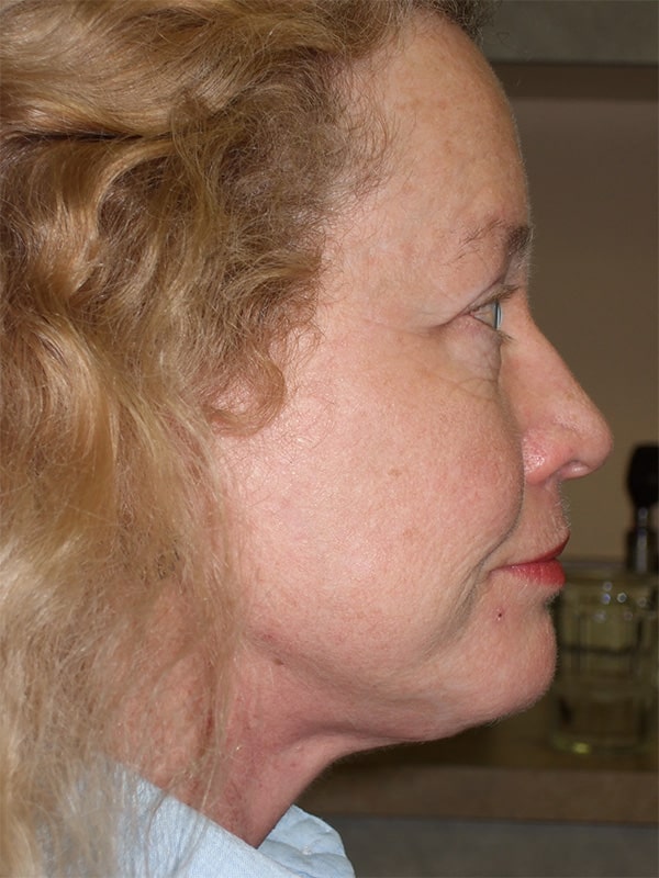 After Image: Facelift, Necklift, Upper & Lower Blepharoplasty, Ptosis Repair and Endoscopic Browlift - right-side
