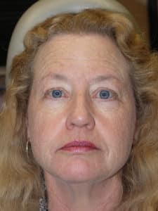 Facelift, Necklift, Upper & Lower Blepharoplasty, Ptosis Repair and Endoscopic Browlift