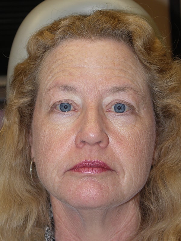 Before Image: Facelift, Necklift, Upper & Lower Blepharoplasty, Ptosis Repair and Endoscopic Browlift - front