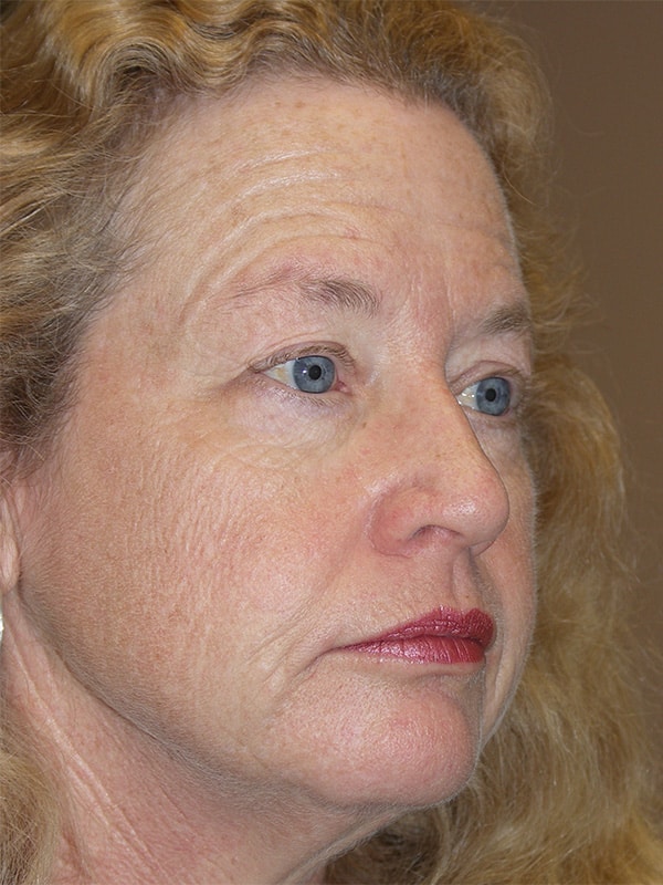 Before Image: Facelift, Necklift, Upper & Lower Blepharoplasty, Ptosis Repair and Endoscopic Browlift - right-front-oblique