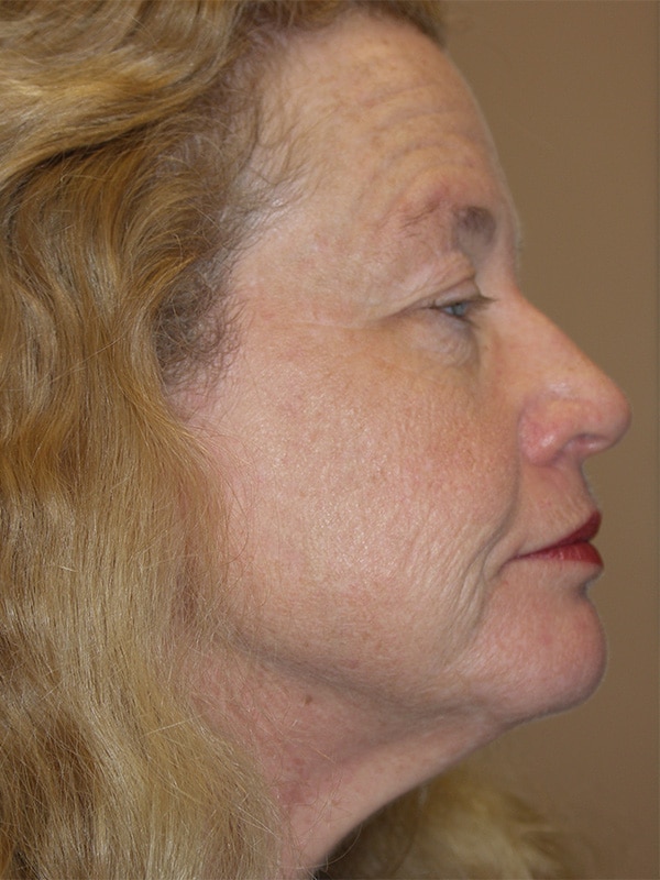 Before Image: Facelift, Necklift, Upper & Lower Blepharoplasty, Ptosis Repair and Endoscopic Browlift - right-side