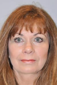 Facelift, Necklift, Endoscopic Browlift, Upper & Lower Blepharolasty and Ptosis Repair
