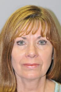 Facelift, Necklift, Endoscopic Browlift, Upper & Lower Blepharolasty and Ptosis Repair