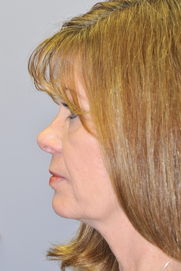 Before Image: Facelift, Necklift, Endoscopic Browlift, Upper & Lower Blepharolasty and Ptosis Repair - left-side