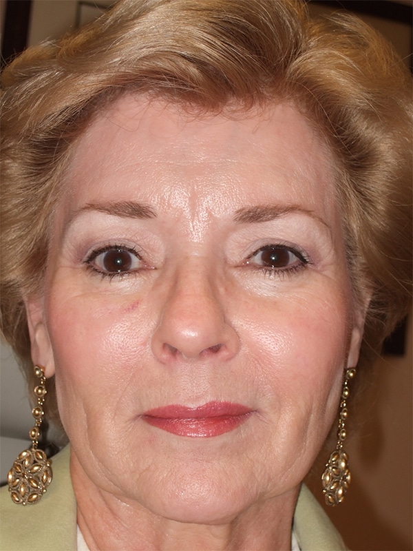 After Image: Endoscopic Browlift and Endoscopic Mid-Facelift - front