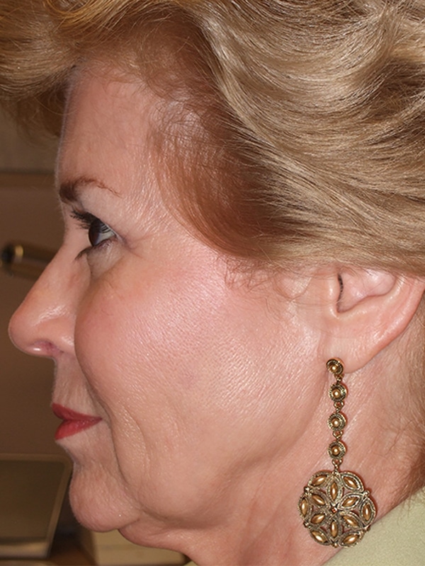After Image: Endoscopic Browlift and Endoscopic Mid-Facelift - left-side