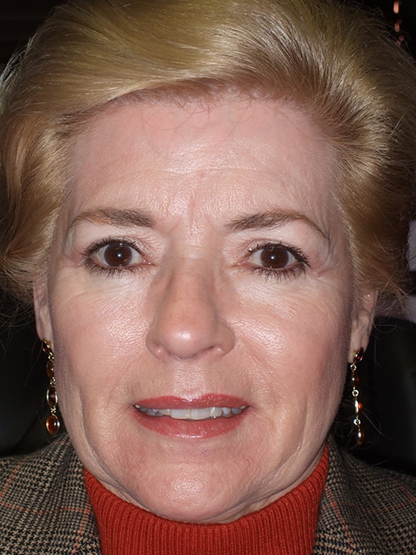 Before Image: Endoscopic Browlift and Endoscopic Mid-Facelift - front
