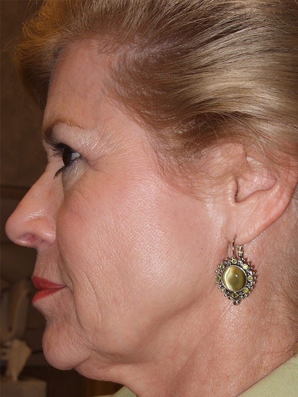 Before Image: Endoscopic Browlift and Endoscopic Mid-Facelift - left-side